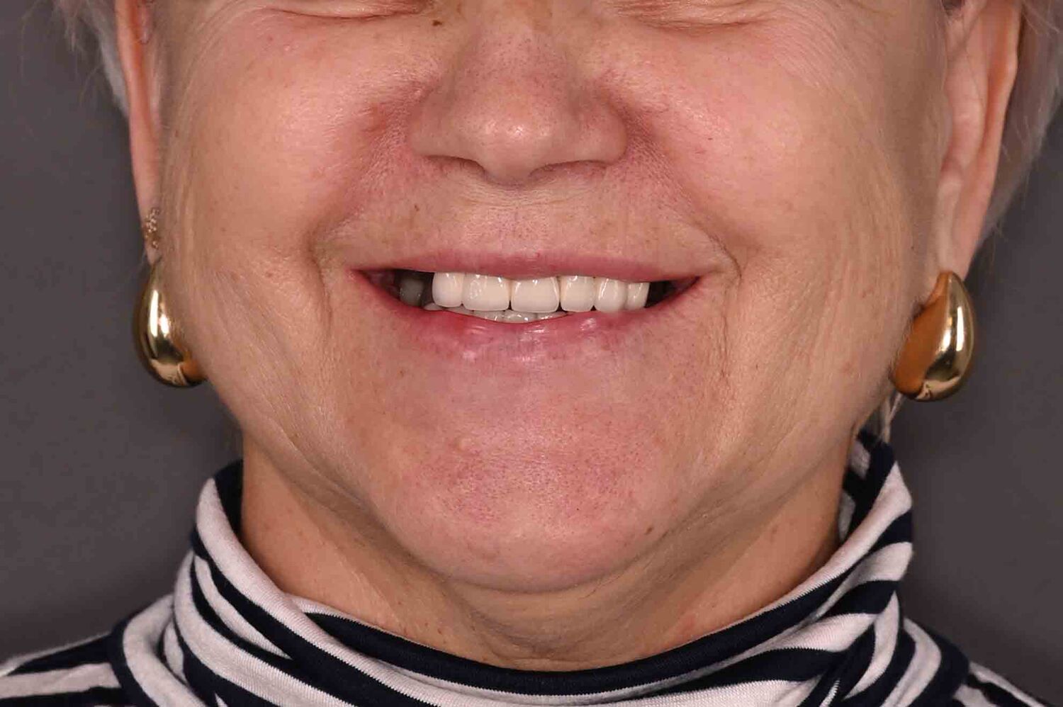 Pacient Clinica Dr. Alin Odor - Rezultat Implantologie